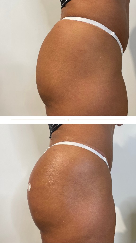 Antes e depois, projeção lateral e contorno arredondado, Caso 1