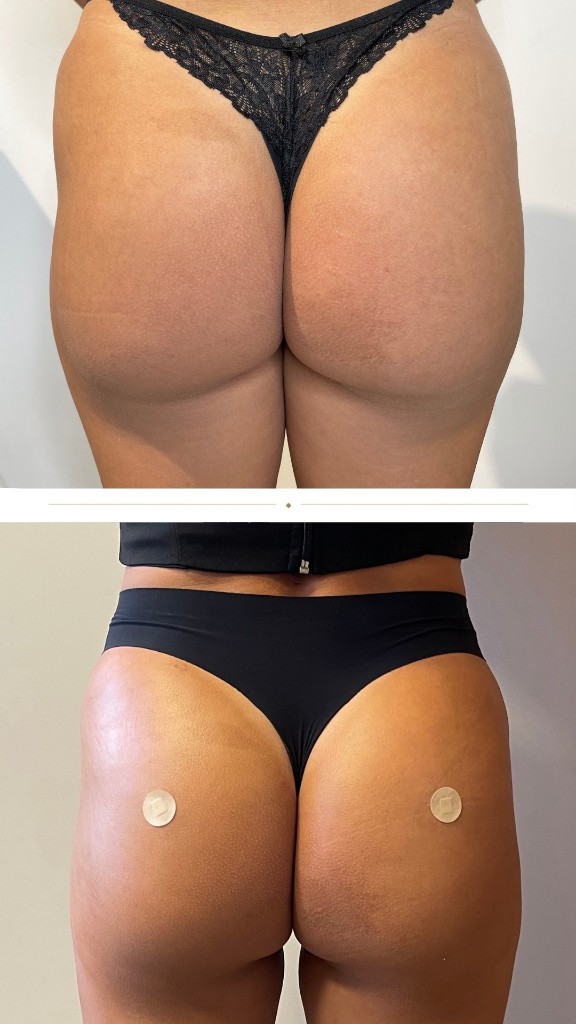 Antes e depois, preenchimento de hip dips e volume superior, Caso 2
