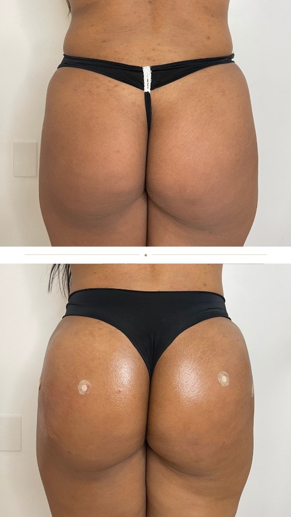 Antes e depois, harmonização lateral e volume superior, Caso 3