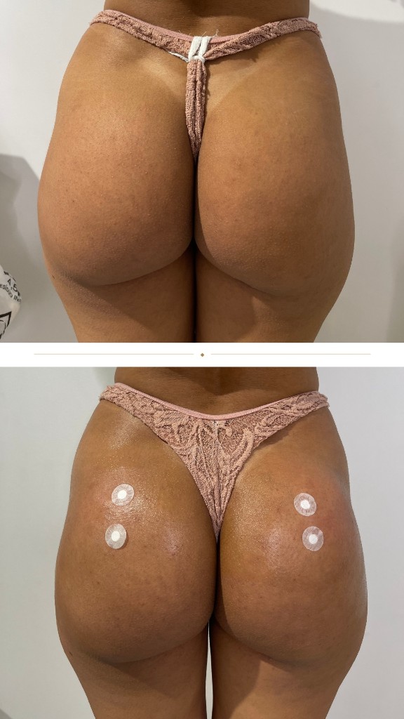 Antes e depois, correção lateral e elevação do contorno, Caso 4